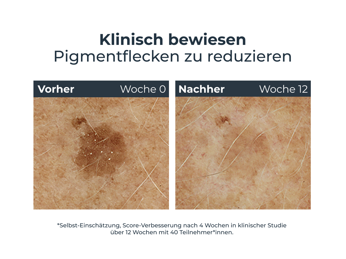 Haut mit Pigmentflecken. Vorher/Nachher. Text: Klinisch bewiesen Pigmentflecken zu reduzieren.